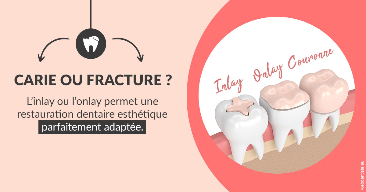 https://dr-madi-caroline.chirurgiens-dentistes.fr/T2 2023 - Carie ou fracture 2