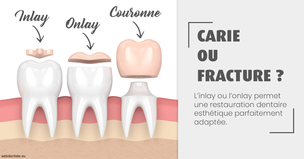 https://dr-madi-caroline.chirurgiens-dentistes.fr/T2 2023 - Carie ou fracture 1