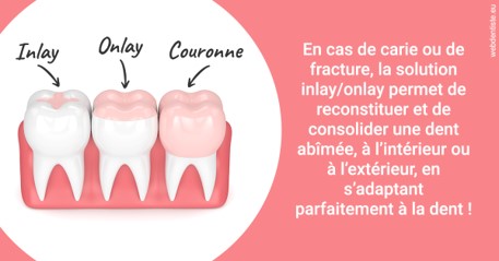 https://dr-madi-caroline.chirurgiens-dentistes.fr/L'INLAY ou l'ONLAY 2