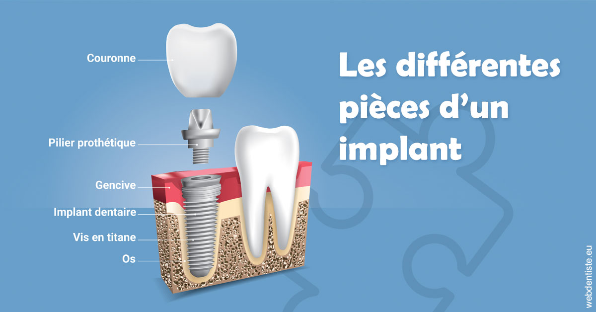 https://dr-madi-caroline.chirurgiens-dentistes.fr/Les différentes pièces d’un implant 1